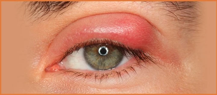 Κριθαράκι ή Χαλάζια: Ποιες οι διαφορές, ποιοι οι τρόποι αντιμετώπισης